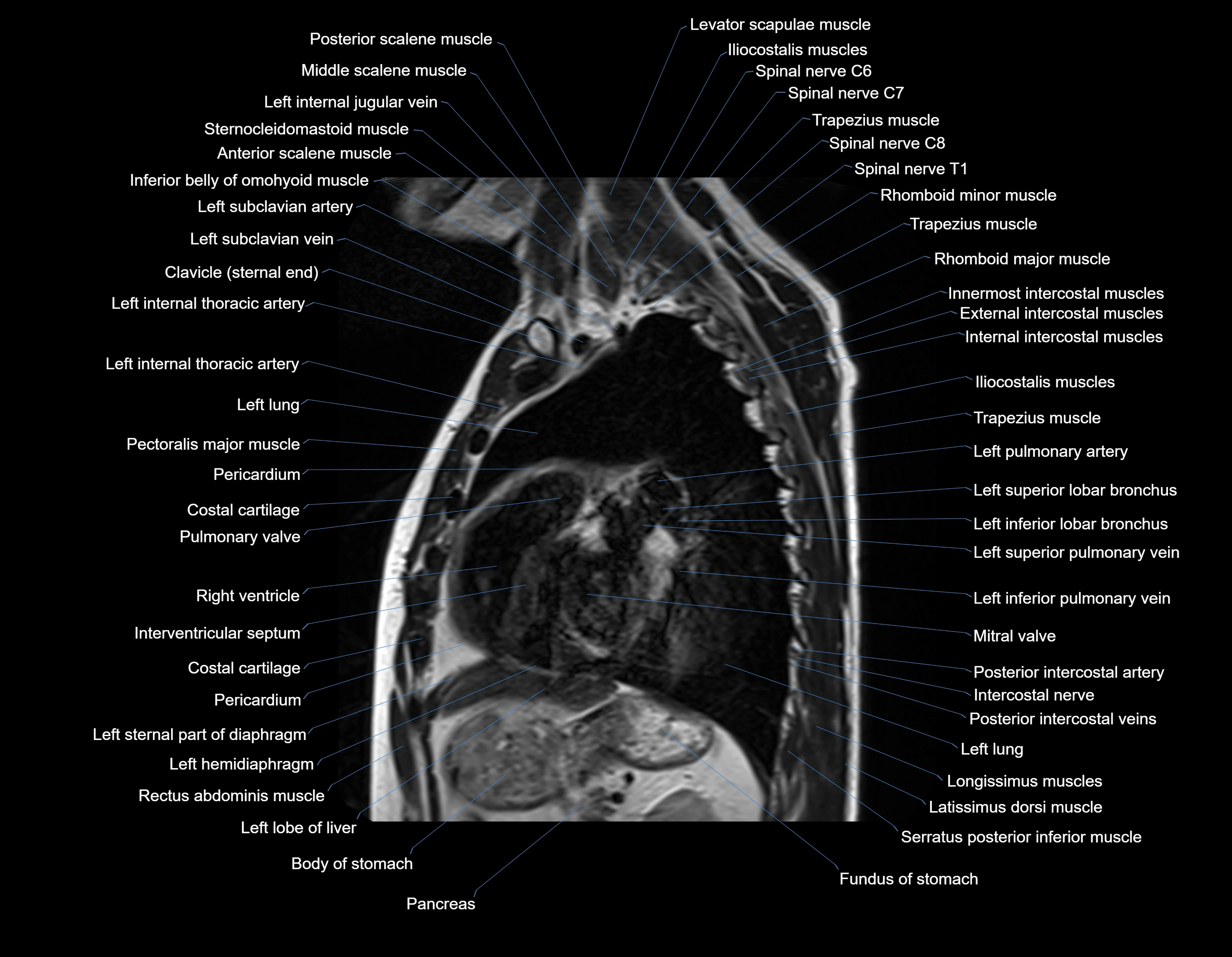 MRI chest (thorax) sagittal labelled cross sectional anatomy 3T radiology image-img-00001-00024.webp